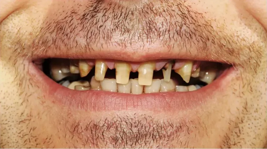 sonrisa antes 2