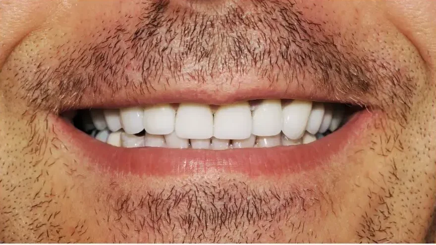 sonrisa despues 2